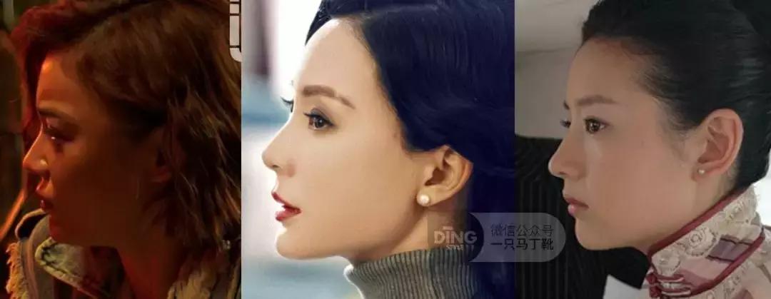 凹面型侧脸怎么改善,凹面型侧脸是怎么造成的