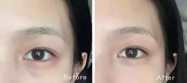 眼袋眼纹黑眼圈改善方法,去黑眼圈眼袋眼纹最有效的小妙招