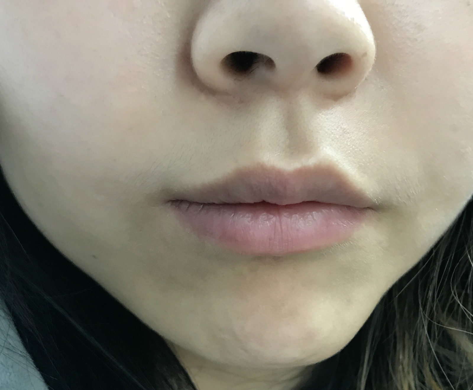 医美收毛孔价格表,医美收毛孔什么方法好