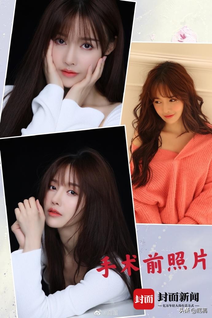 演员高溜整容失败鼻子坏死,演员高溜整容鼻子坏死