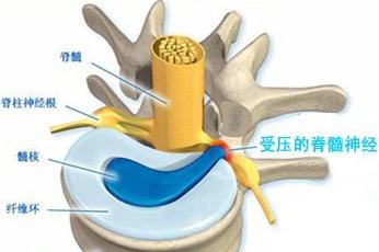 什么是腰突什么是膨出怎么区分？