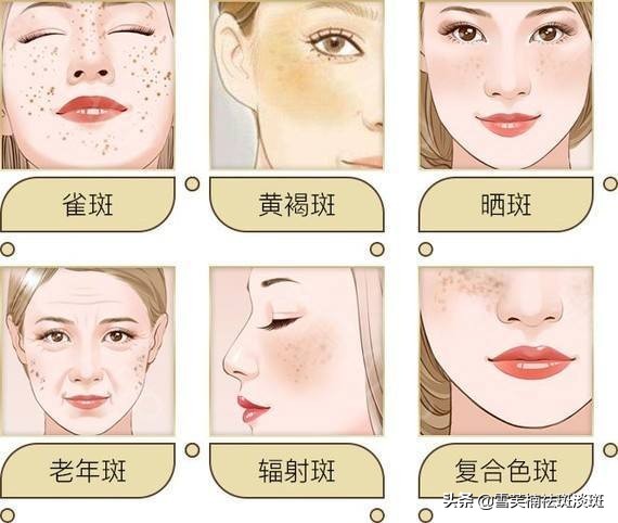 去斑点淡斑最有效方法,去斑点的最好方法最快最有效果
