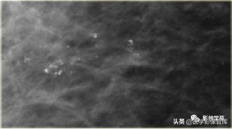 乳腺钙化怎么区分良性和恶性,乳腺钙化的诊断与分级