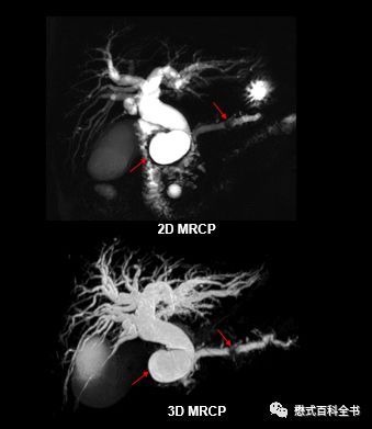 开展mrcp技术,mrcp检查操作流程