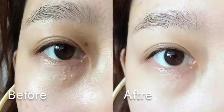 别再用针挑！用米澳拉，脂肪粒自己“掉”下来，效果胜过医美激光