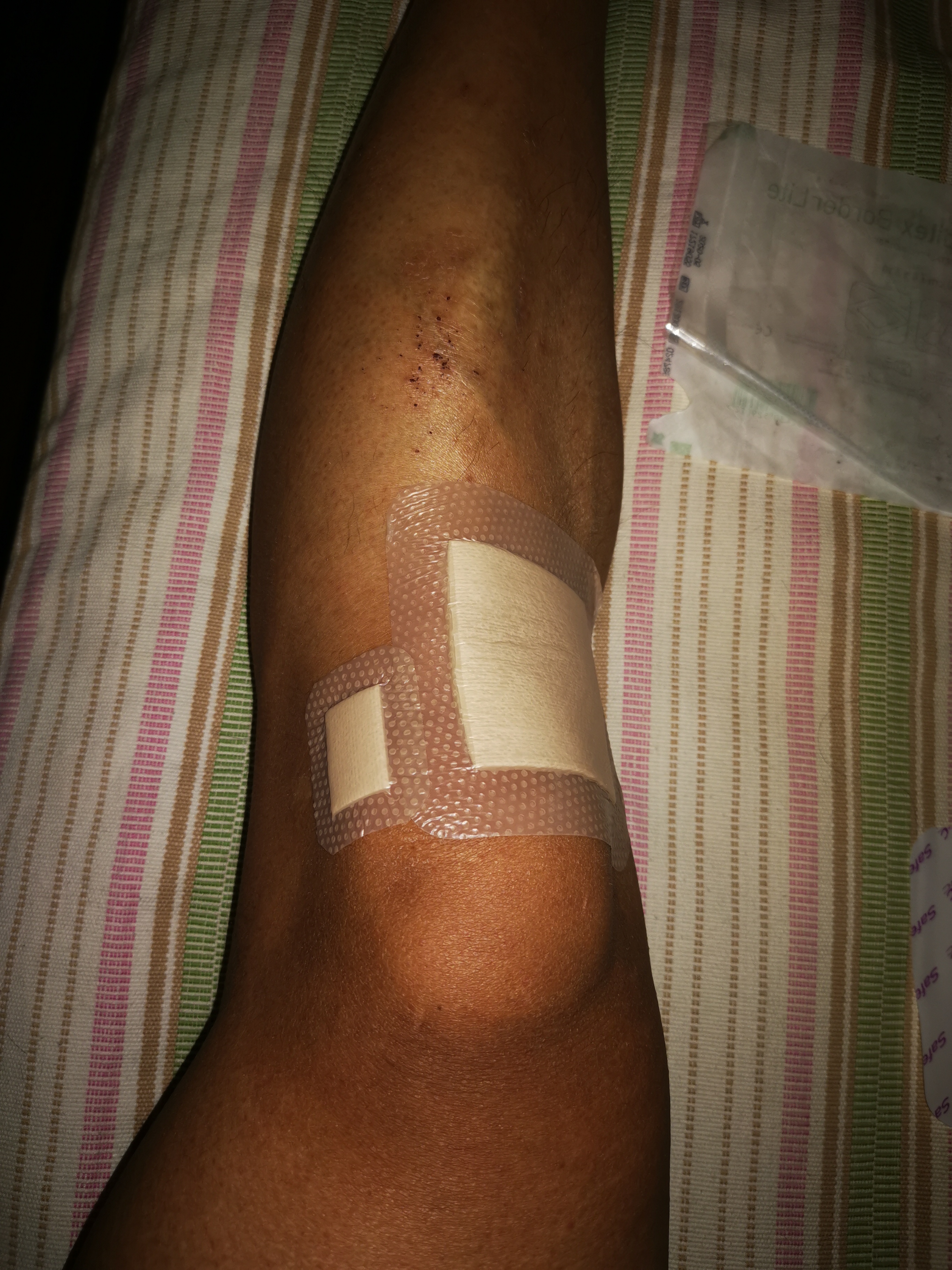 瑞典墨尼克敷料,瑞典墨尼克美皮护疤痕贴有效吗