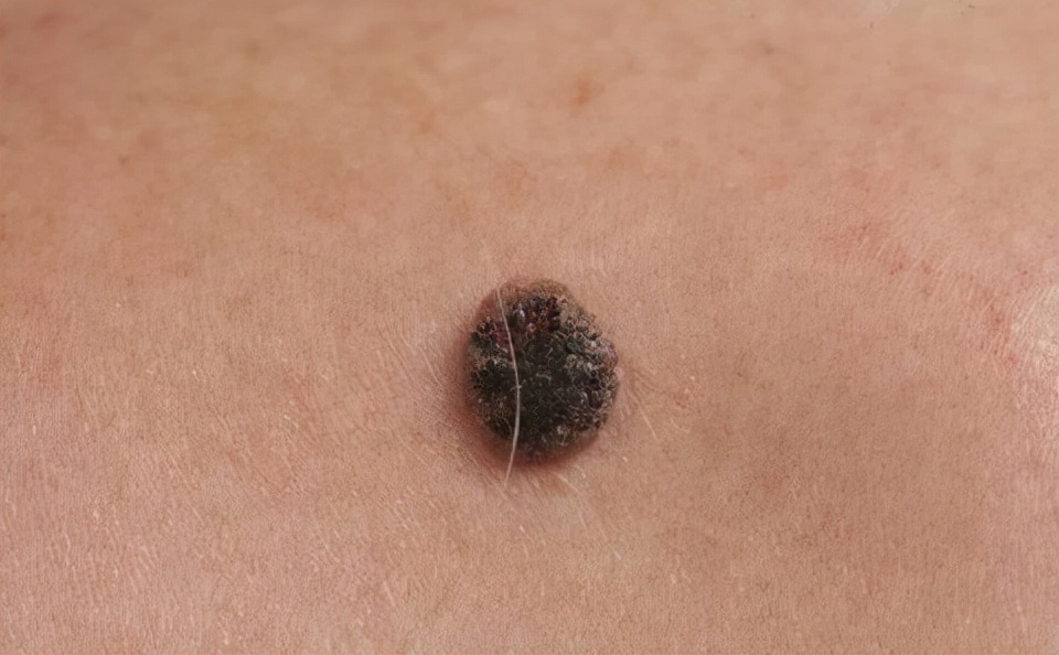 皮肤外面长了大的软肉球不痛不痒,皮肤上长小肉疙瘩如何确定是什么