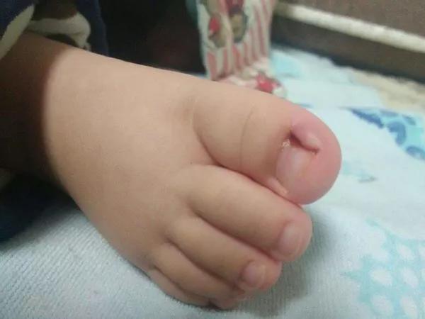 宝宝脚趾甲往肉里长怎么剪,宝宝脚趾甲长到肉里怎么办