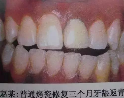 如何挑选烤瓷牙材料,怎样选择适合你的烤瓷牙