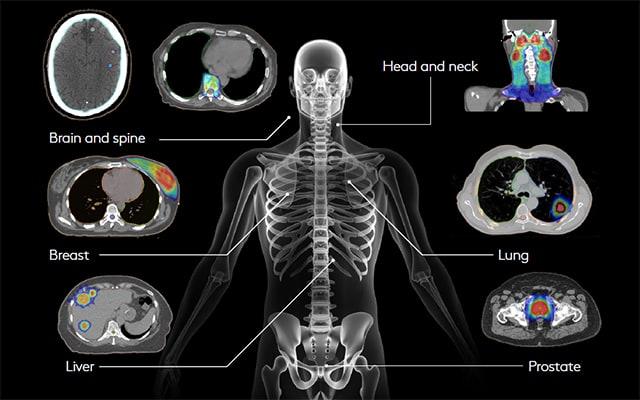 肿瘤放疗的*击狙**手——医科达Infinity直线加速器