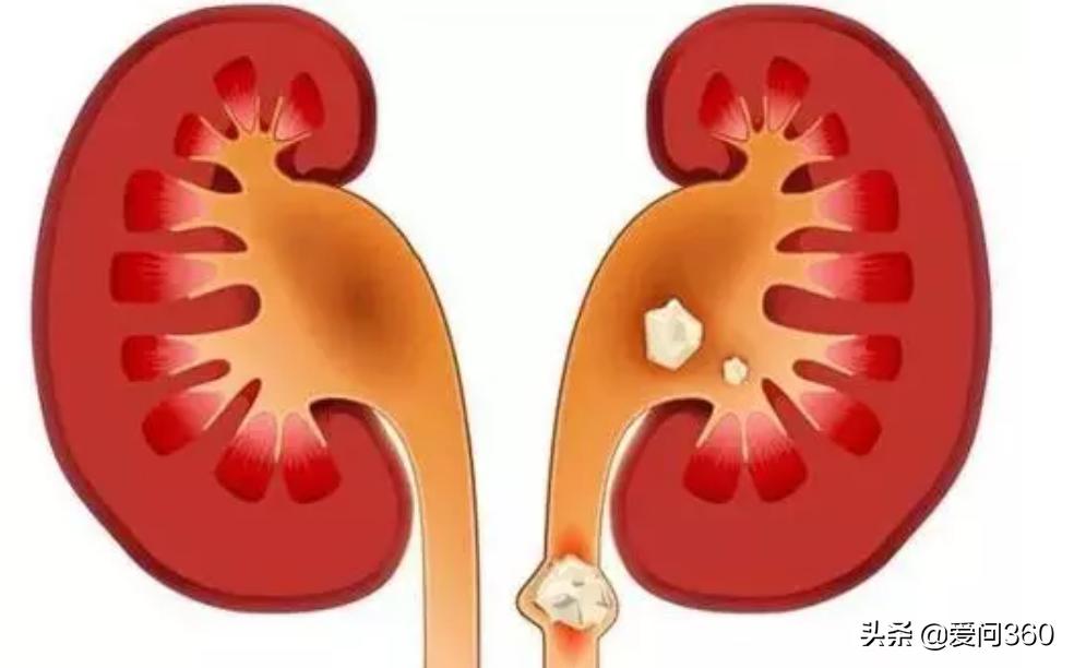肾结石通常是什么原因造成的,肾结石是怎么形成的有什么方法