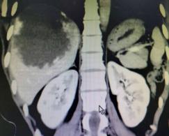 20cm肝血管瘤手术失败,8公分肝血管瘤切除肝脏