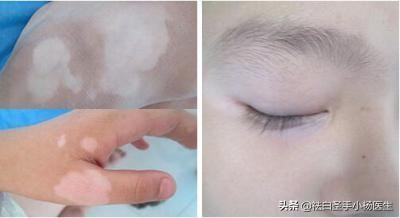 身上长白斑是白癜风吗如何确诊,小孩身上有白斑是白癜风还是汗斑