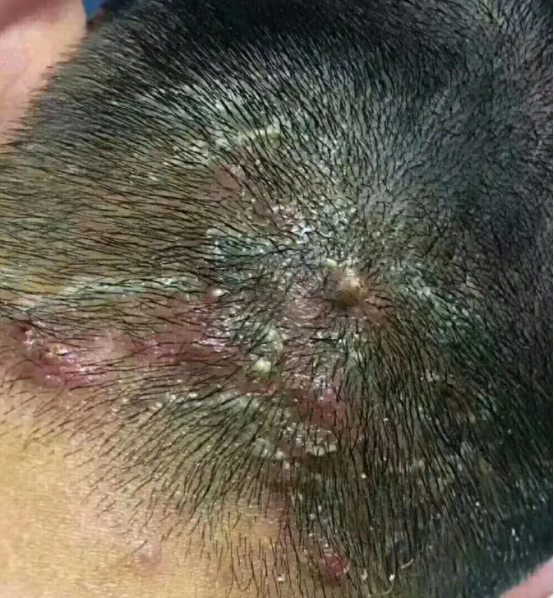 毛囊炎反复怎么调理,毛囊炎反复怎么治才断根