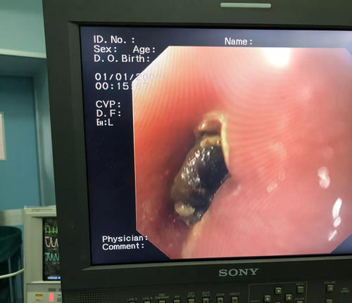 小孩吞了纽扣电池进入小肚子,宝宝误吞纽扣电池能拉出来吗