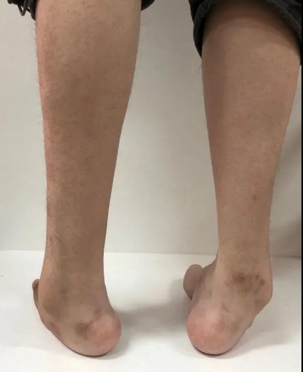 甘肃省妇幼保健院生殖中心成功应用第三代试管婴儿技术阻断“腓骨肌萎缩症”向子代传递，出生健康宝宝