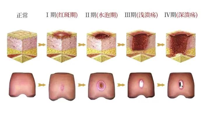 老年人的褥疮是什么样,褥疮病的鉴别诊断