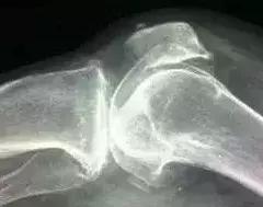 脚长骨刺最好的治疗方法,腰椎骨刺增生彻底治疗方法