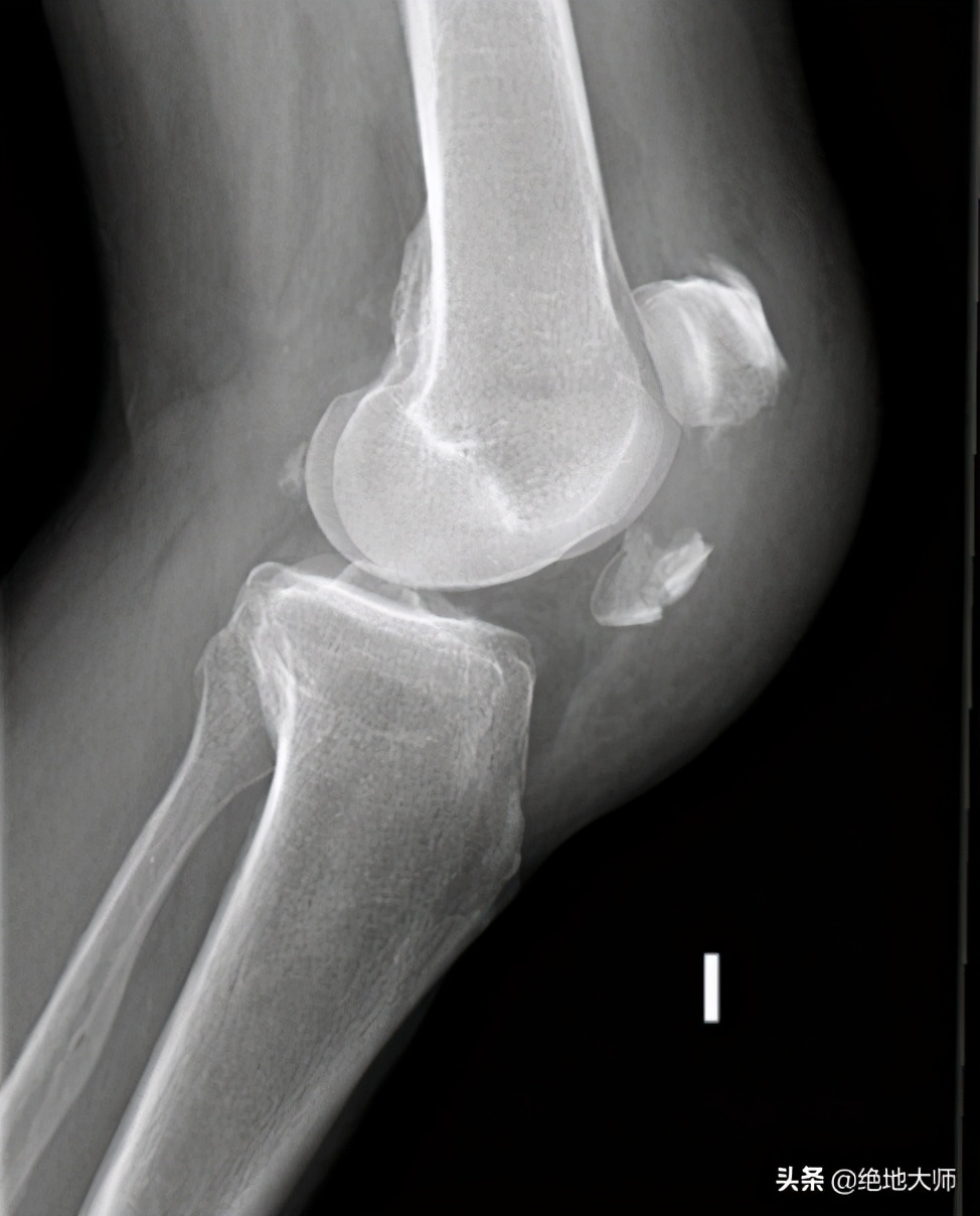 膝关节疼痛用神经阻断疗法,膝关节的疼痛与治疗综述