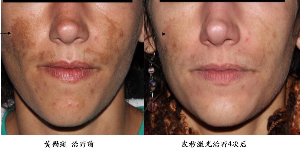 皮秒激光伤皮肤吗,皮秒激光能治凹陷疤痕吗