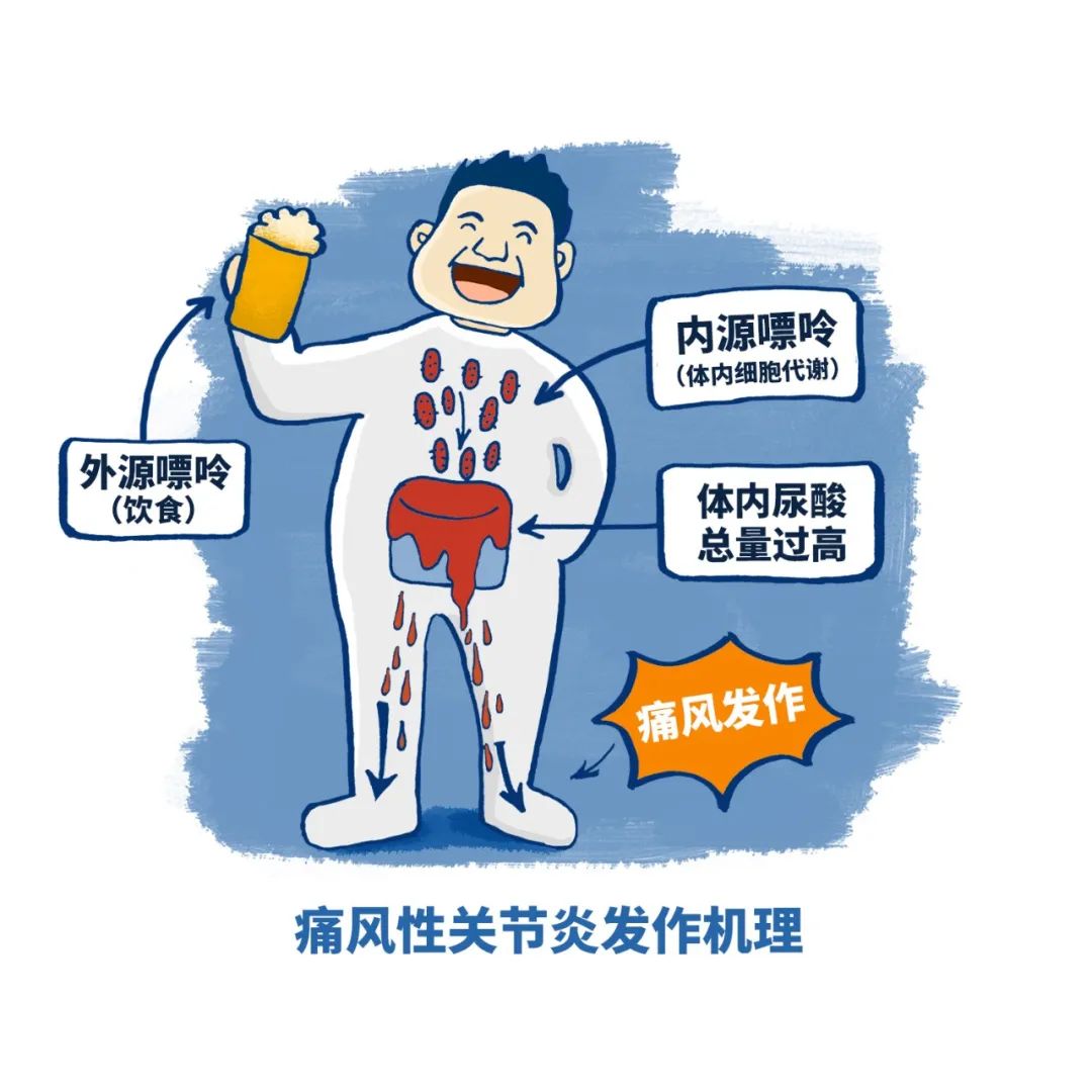 为什么吃降尿酸药痛风会发作,为什么吃着降尿酸的药还会痛风