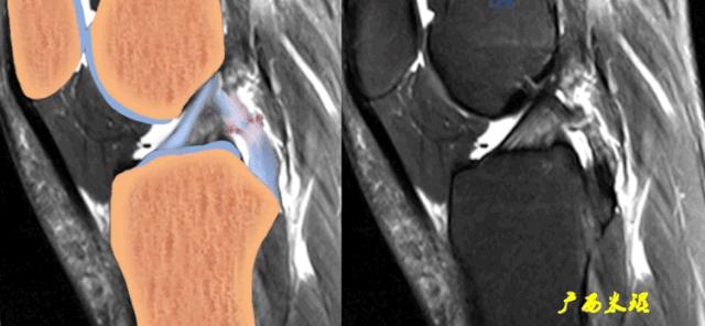 交叉韧带损伤的mr表现,后交叉韧带损伤的诊断实验