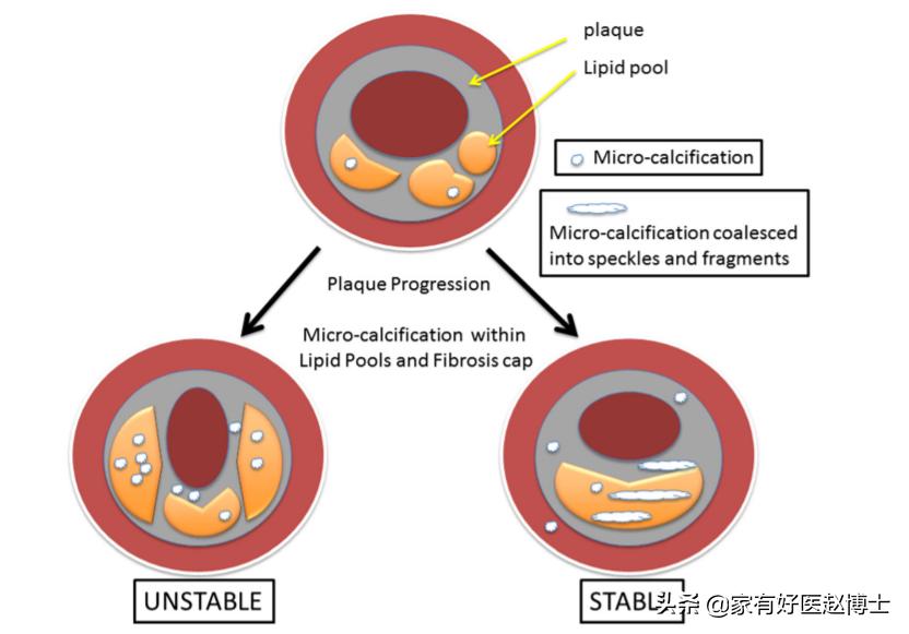 体检显示部分脑动脉钙化,体检显示冠状动脉钙化要紧吗