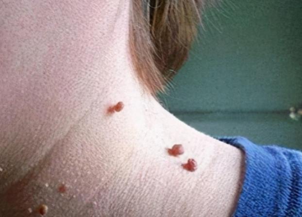 脖子上长的小肉粒可以揪下来吗,脖子腋下长小肉粒可以用手揪掉吗