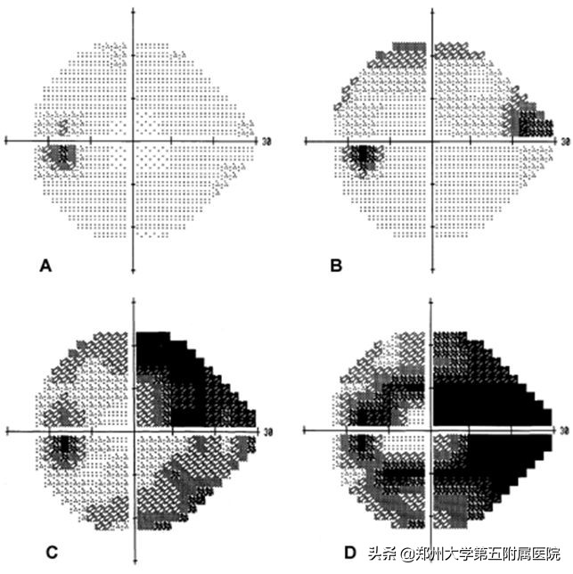 年轻人须警惕青光眼偷走“光明”,警惕青光眼偷走你的视力