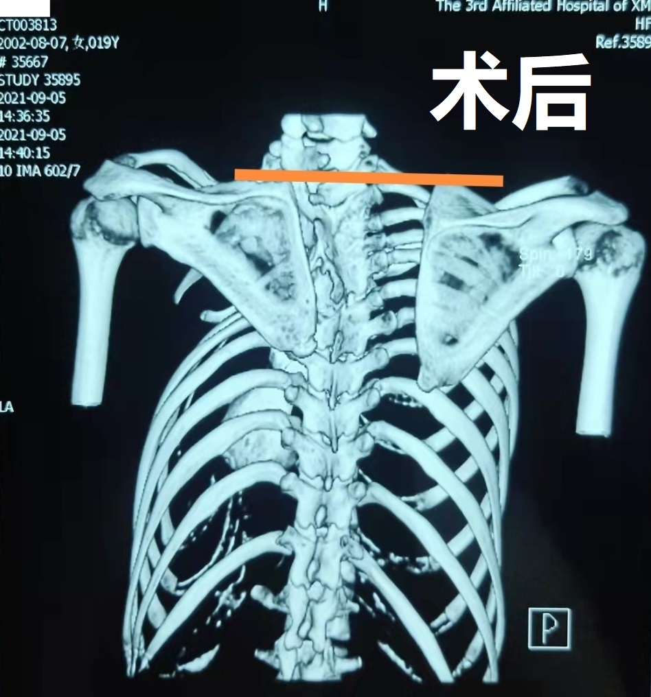 十九年高肩胛少女千里求医终得所愿