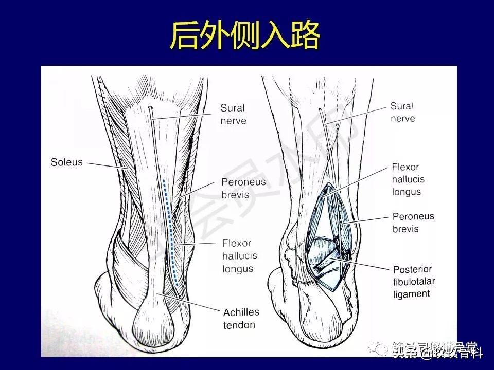 距骨骨折后遗症,距骨骨折怎么办