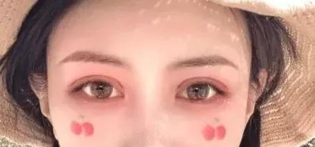 欧式双眼皮适用什么眼型,双眼皮平行型和欧式型有什么区别