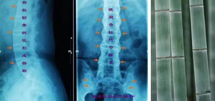 强直性脊柱炎建议生孩子吗,强直性脊柱炎会危害下一代吗