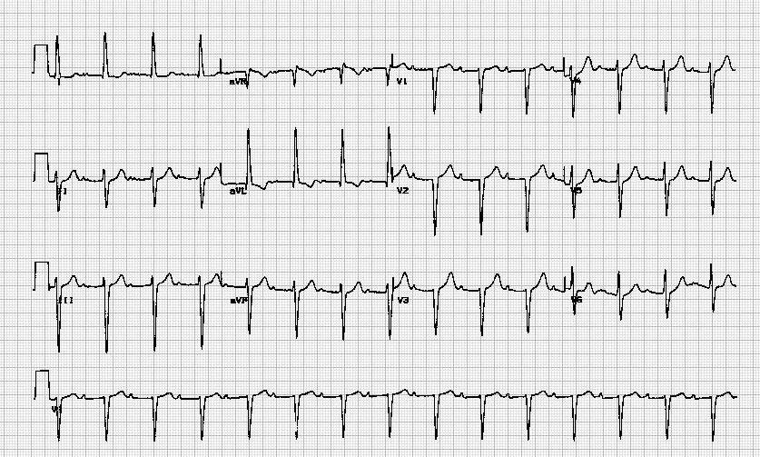 目前副作用最小的抗精神分裂症药,精神类药物副作用停药多久消失