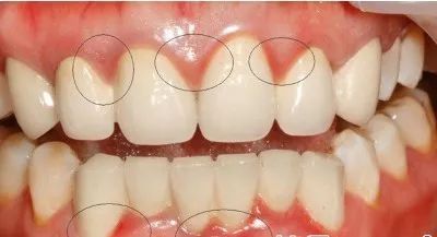 智齿向脸颊方向长一定要拔吗,40岁智齿横着长一定要拔吗