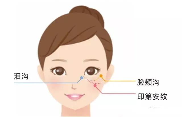 皮肤衰老了，长了印第安纹怎么办？