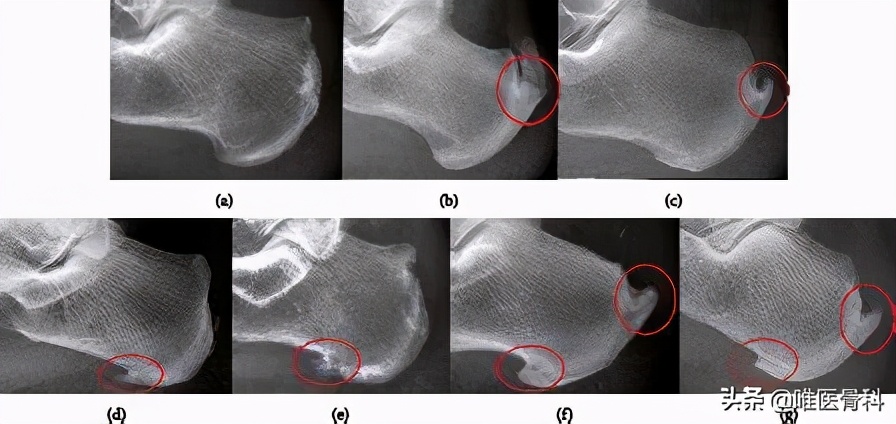 40-60岁脚后跟疼吃什么药,40-60岁脚后跟疼有啥办法
