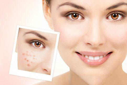 脸上痘痘敷什么快速消炎,简单三招教你告别痘痘痘印