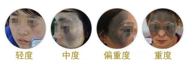 怎样辨别太田痣,婴儿太田痣扩散到几岁能稳定