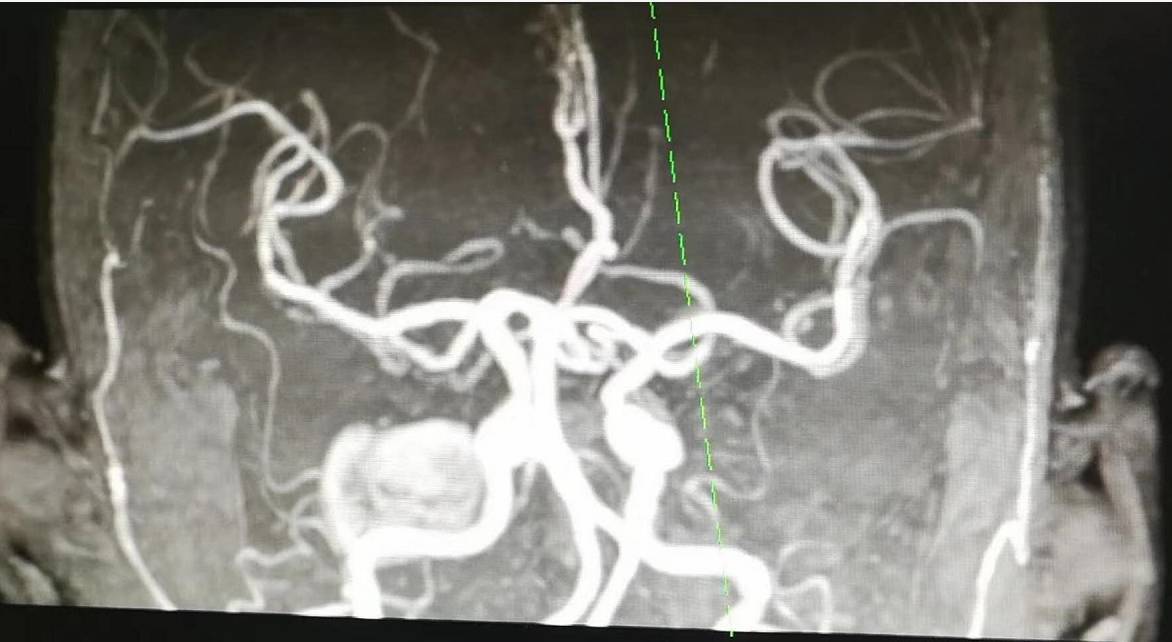 如何预防原发性直立性低血压,直立性低血压发病机制