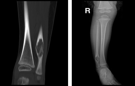 骨纤维结构不良是骨肿瘤吗？孩子高发，怎么才能发现呢？