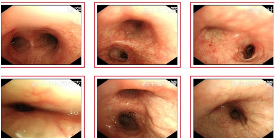 鍖荤敓鏃犳硶鍒ゆ柇缁撹妭鐥呰繕鏄粨鏍哥梾,鏈夎偤缁撴牳鐥呭彶鍗佸嚑骞存煡鍑鸿偤缁撹妭