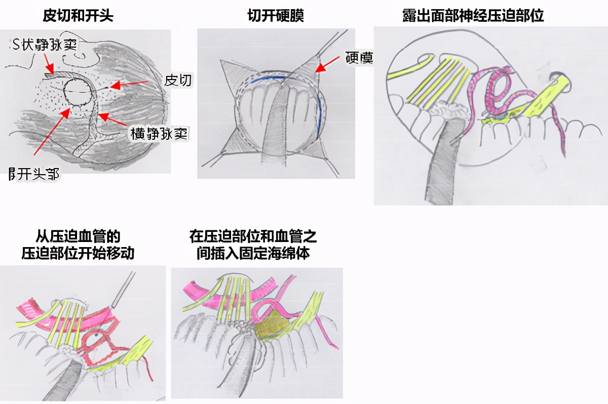 女子多年耳鸣被中医治好,55岁女耳鸣一年多不影响睡眠