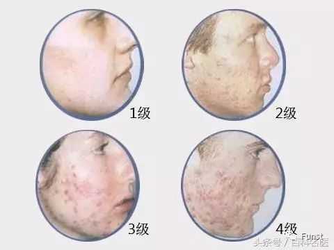 看到就是赚到的护肤好物,真正有效的祛痘产品推荐