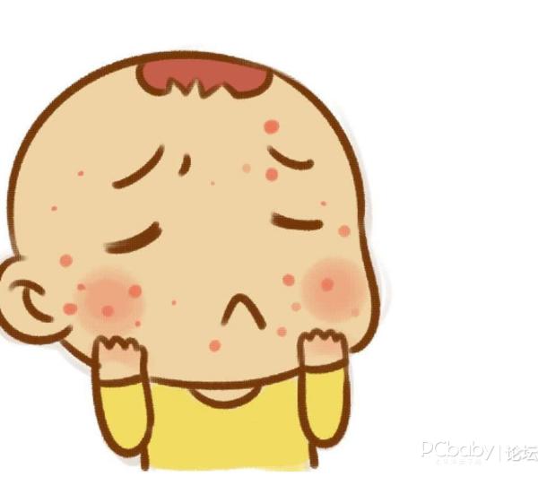 新生儿湿疹怎么办崔玉涛,新生儿湿疹怎么办