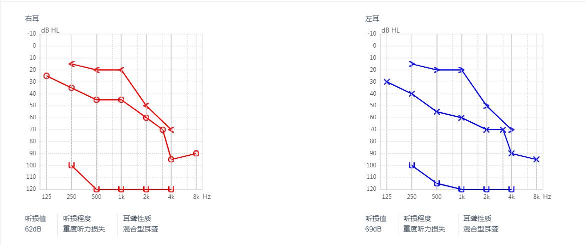 好好的就耳鸣怎么回事,耳聋预防和治疗