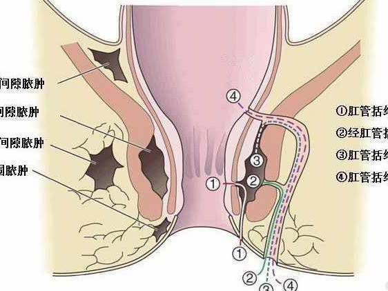 肛瘘手术比生孩子还痛吗,做完肛瘘手术疼痛怎么解决