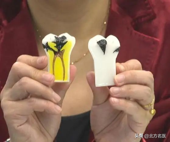 牙上有个小黑点该怎么治疗,牙上小黑点千万莫忽视