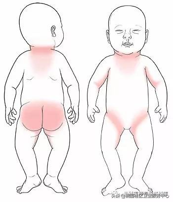 儿童湿疹和痱子要分清楚,成人痱子和湿疹如何分别