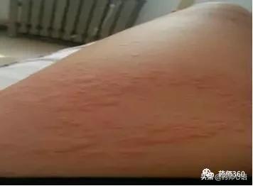 麻疹有什么中成药,常见人工荨麻疹的治疗方法有哪些